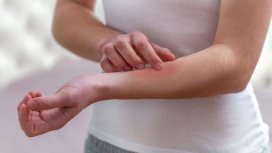 Remédios que nos pueden ayudar a combatir la psoriasis